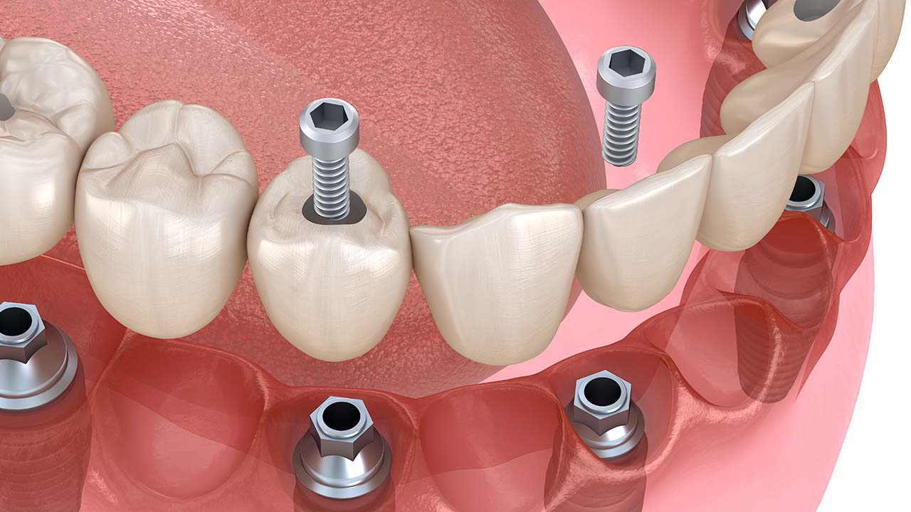 Impianto dentale a carico immediato - Equipe Dentale - Arezzo