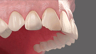 Faccette dentali non invasive