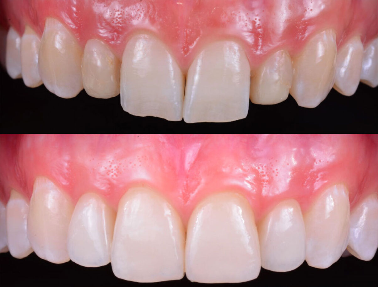 Close Up denti prima e dopo trattamento con faccette