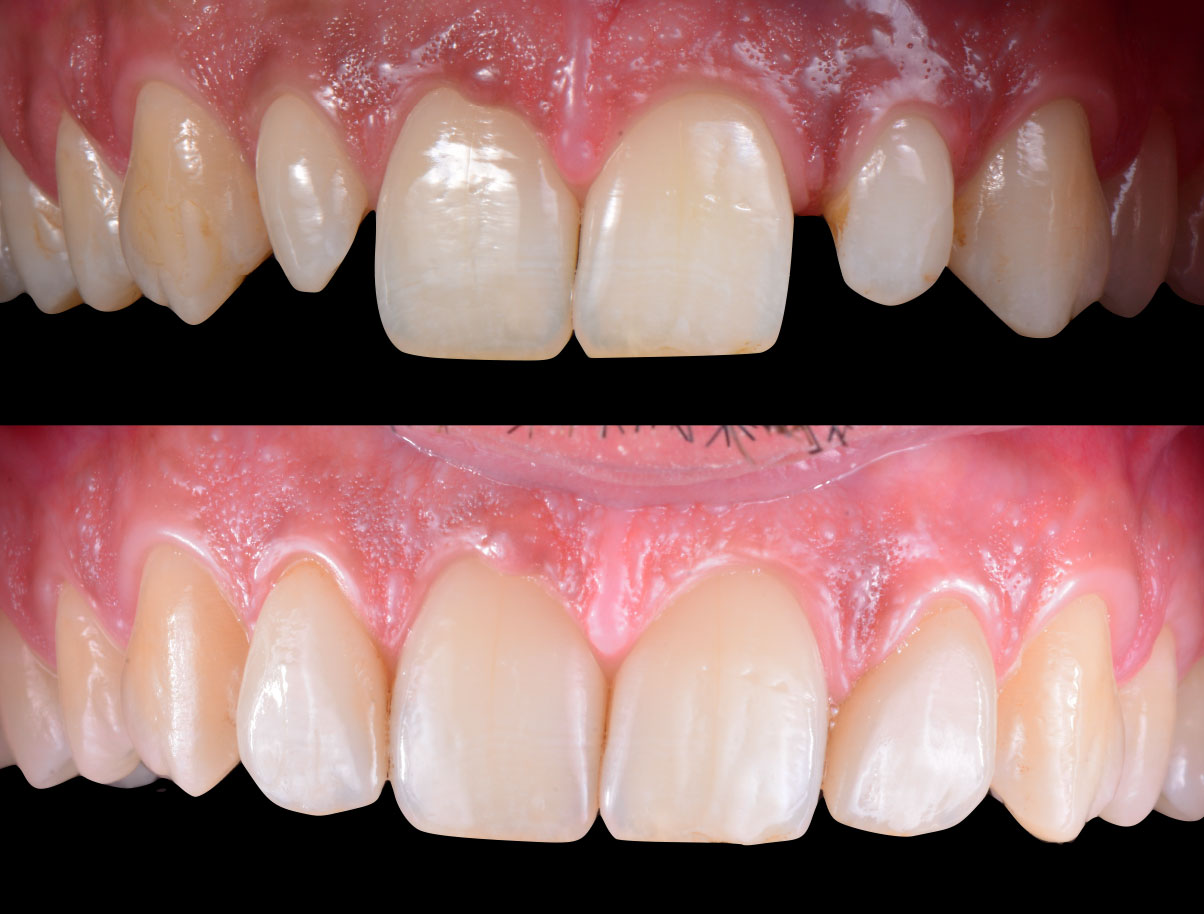 Close up denti prima e dopo trattamento con faccette