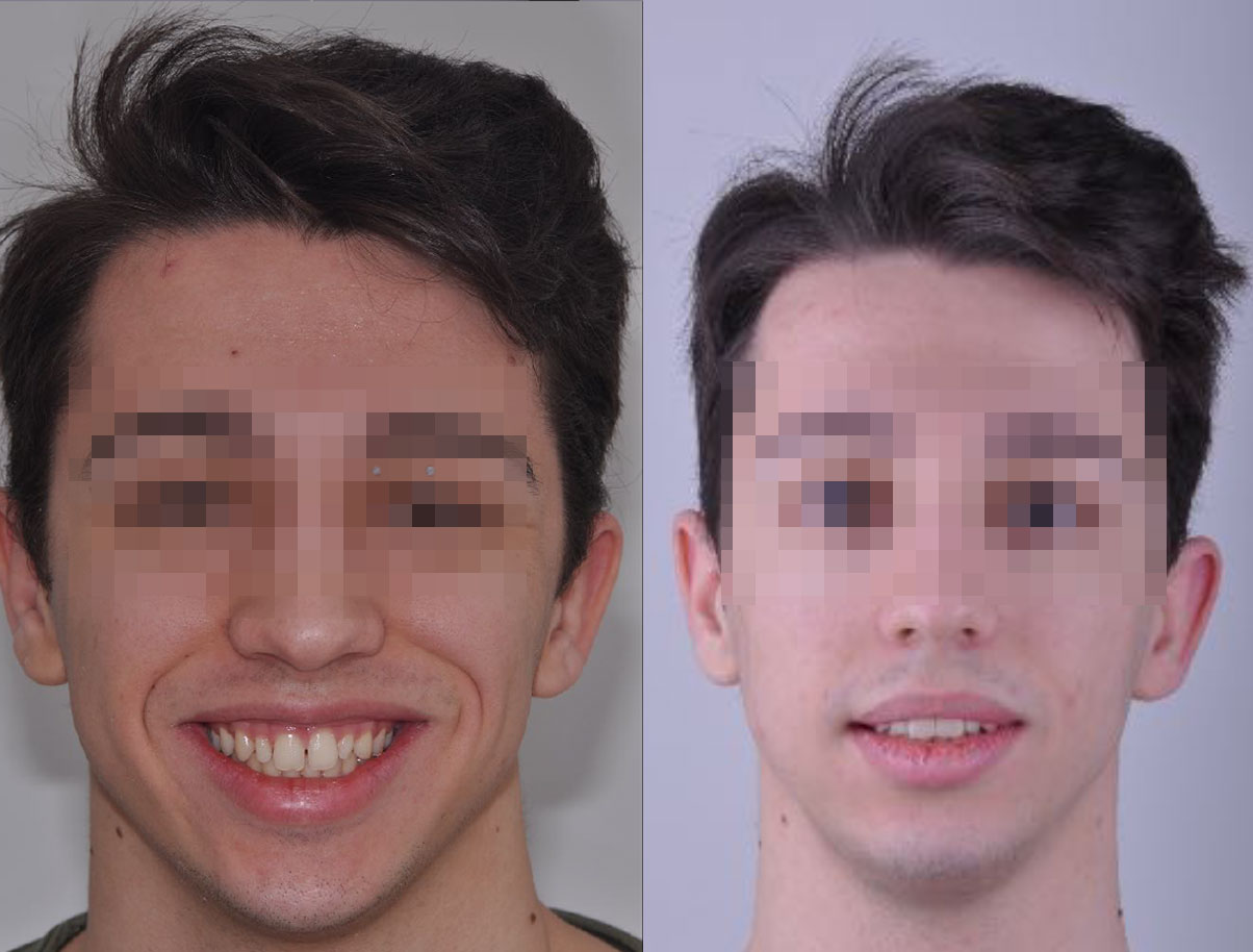 Enrico prima e dopo il trattamento con faccette dentali