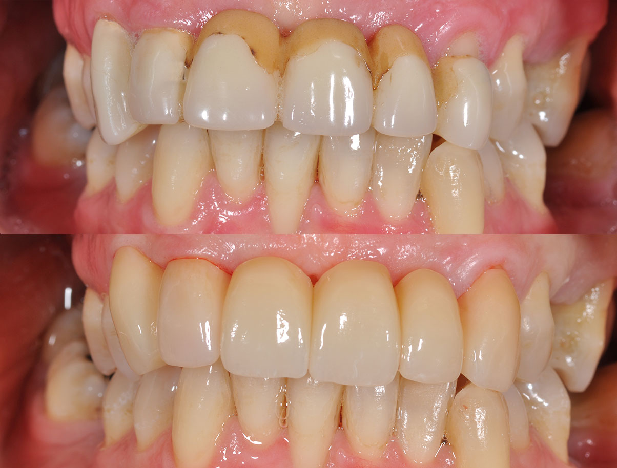 Close Up trattamento denti Francesca