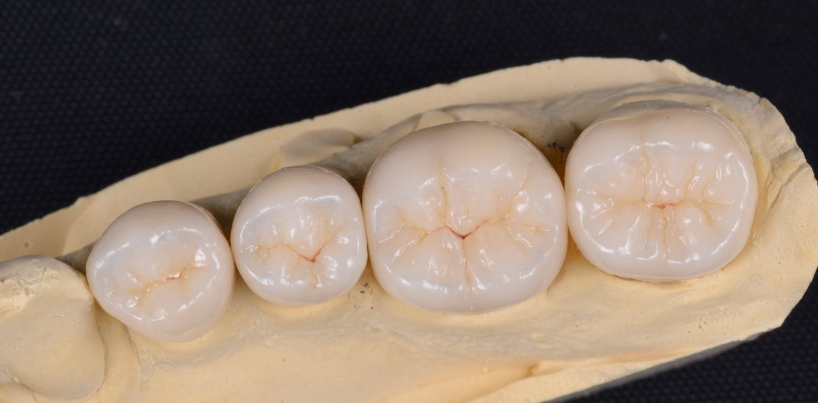 Intarsi protesi centro equipe dentale